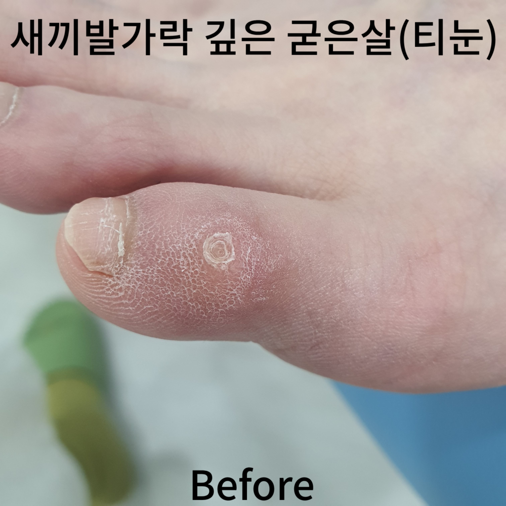 새끼발가락 단단한 굳은살(티눈)관리 - 풋스올 은평연신내점