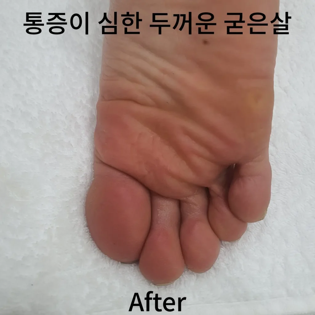 통증이-심한-두꺼운-굳은살-오른발-후-사진