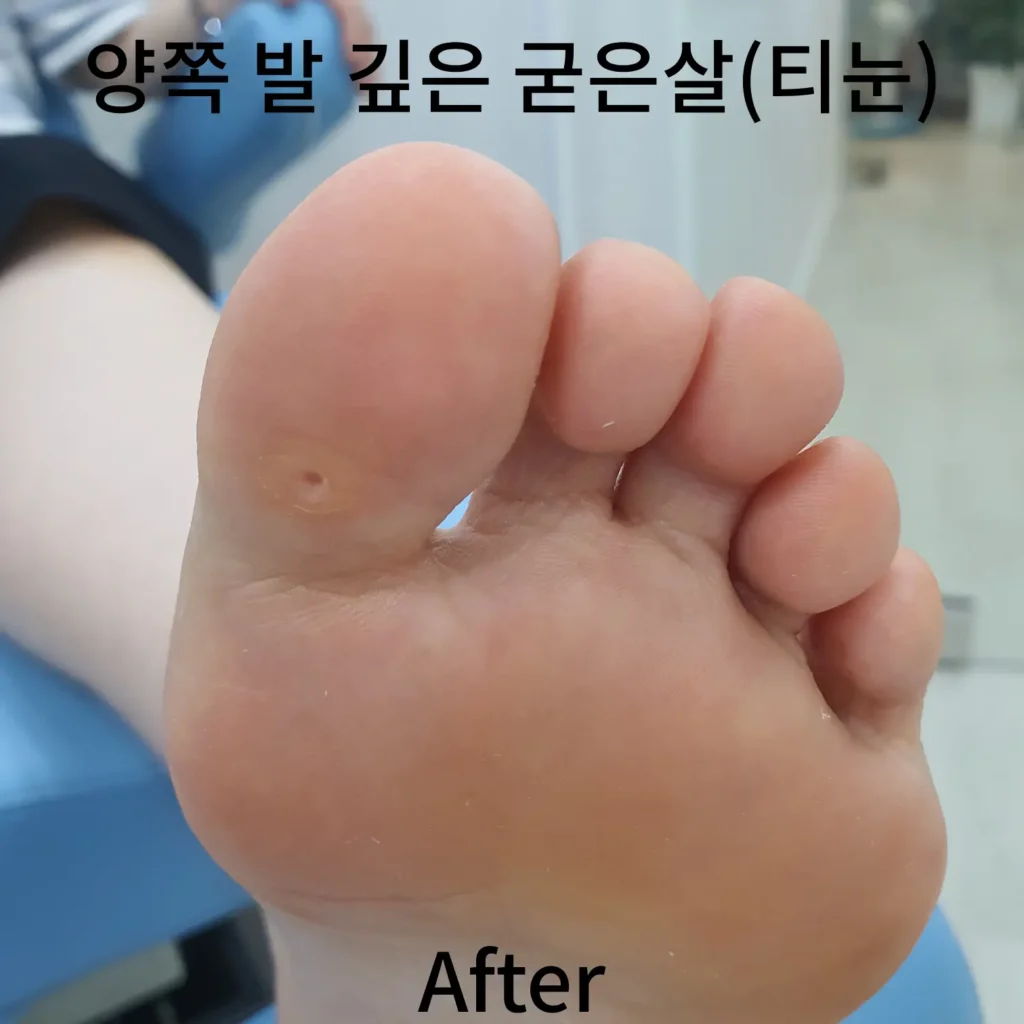 양쪽-발-깊은-굳은살-오른발-후-사진