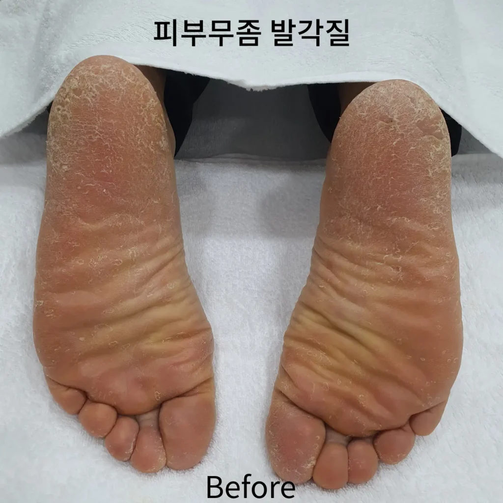 피부무좀-발각질-전체-사진