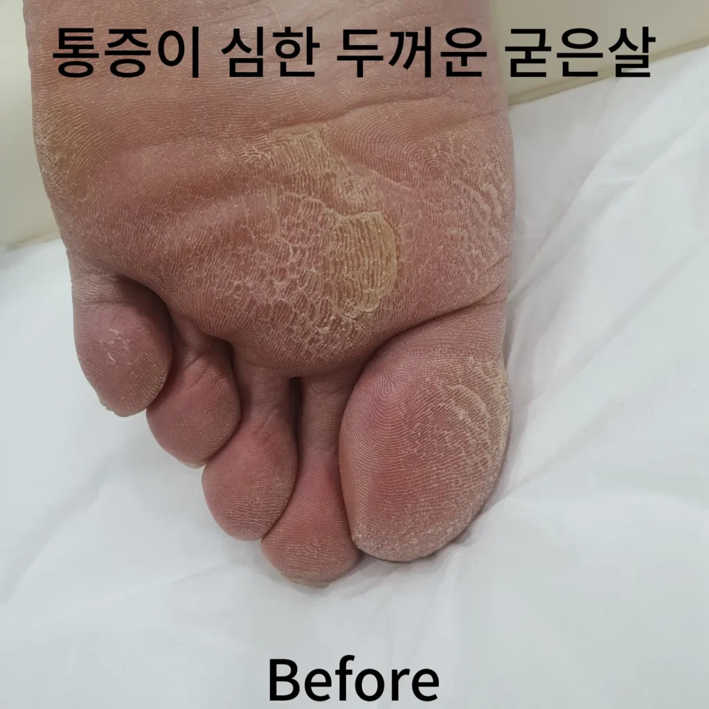 통증이-심한-두꺼운-굳은살-왼발-전-사진