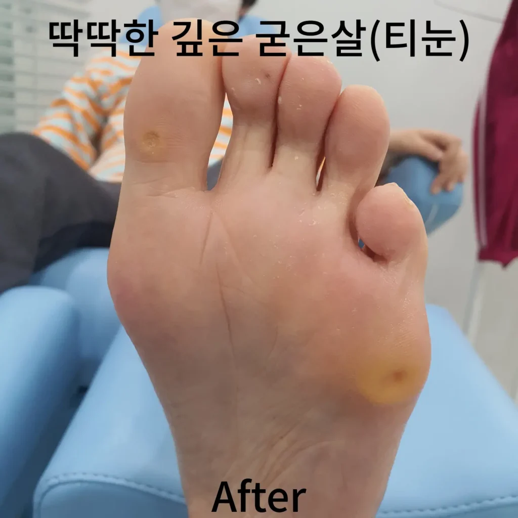 딱딱한-깊은-굳은살-티눈-오른발-후-사진