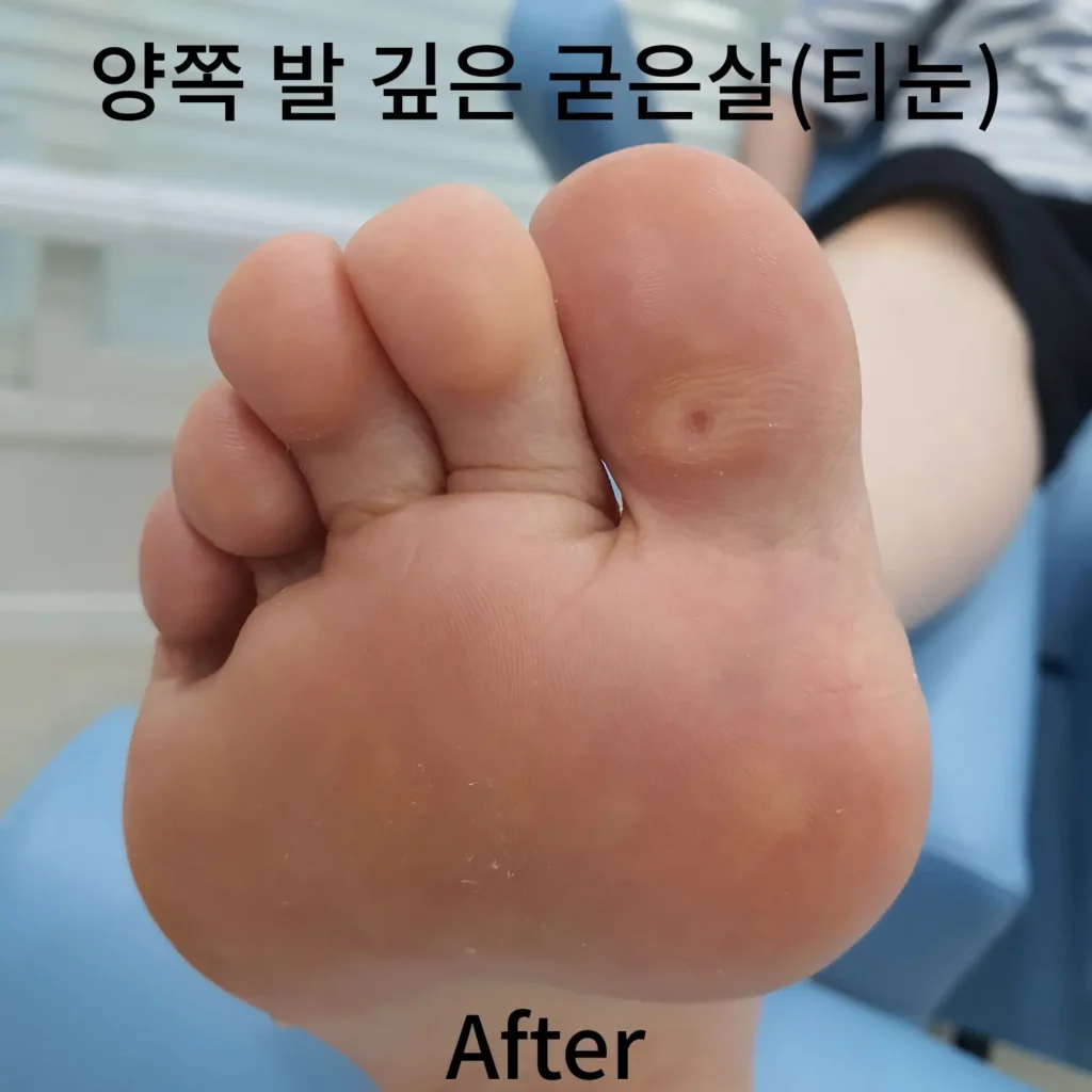 양쪽-발-깊은-굳은살-왼발-후-사진