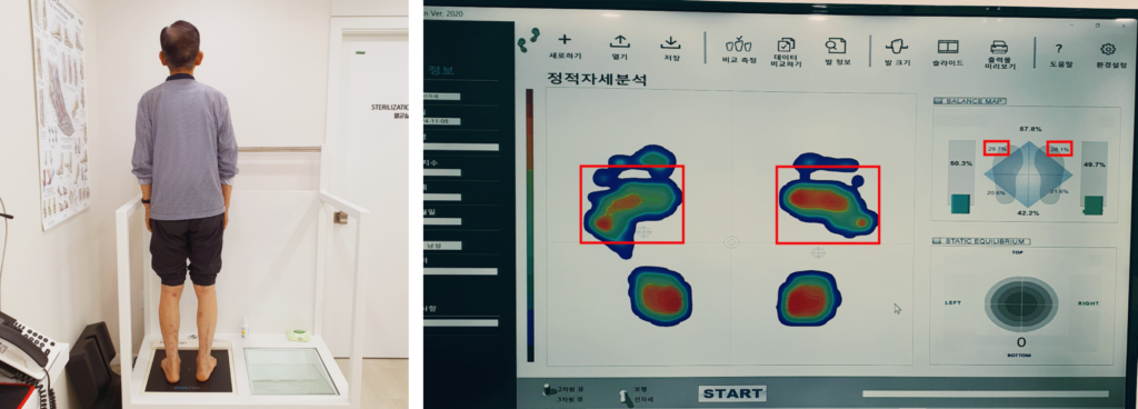 왼쪽 이미지는 한 사람이 발 분석 장비 위에 서 있는 모습으로, 발의 정렬 상태를 측정하고 있습니다. 오른쪽 이미지는 발의 압력 분포와 균형 상태를 시각적으로 나타낸 분석 화면으로, 빨간색 상자로 강조된 부분이 발바닥의 특정 압력 지점을 보여줍니다. 이 이미지는 발 건강과 균형 분석을 설명하는 데 사용됩니다.